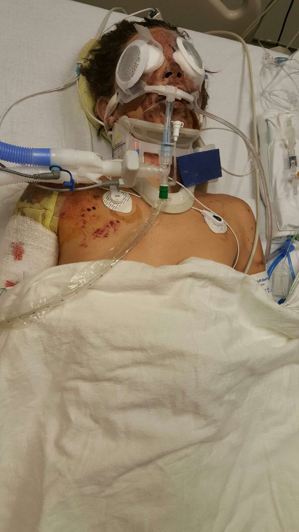 Texas teen maimed after sparkler bomb mishap over holiday  pic photo