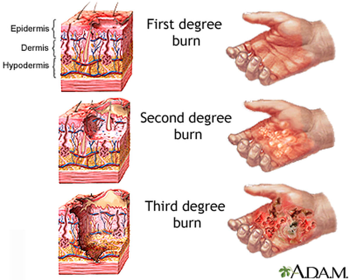 second degree burn treatment