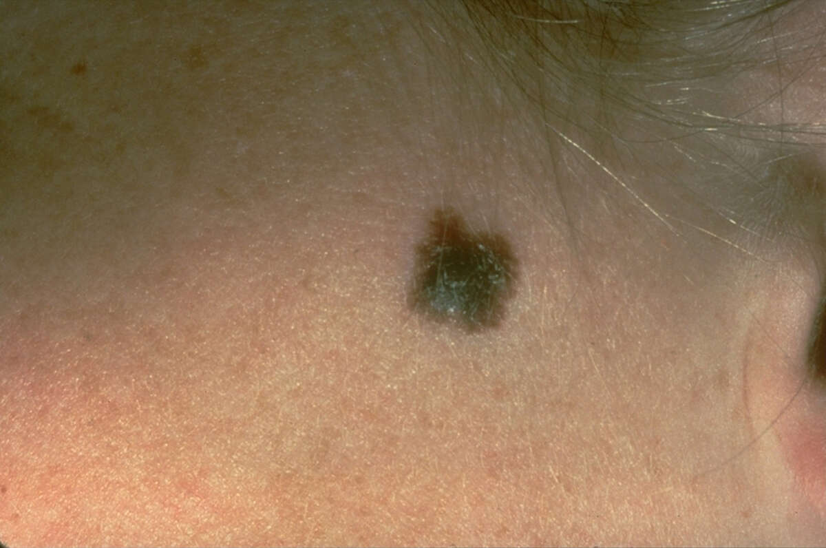 Increasingly, patients are turning to teledermatology, in which they receive diagnosis and treatment for skin conditions without making an in-person doctor’s visit. One method of teledermatology involves sending a “selfie” of a skin condition — such as the mole in this photo — to their doctor.