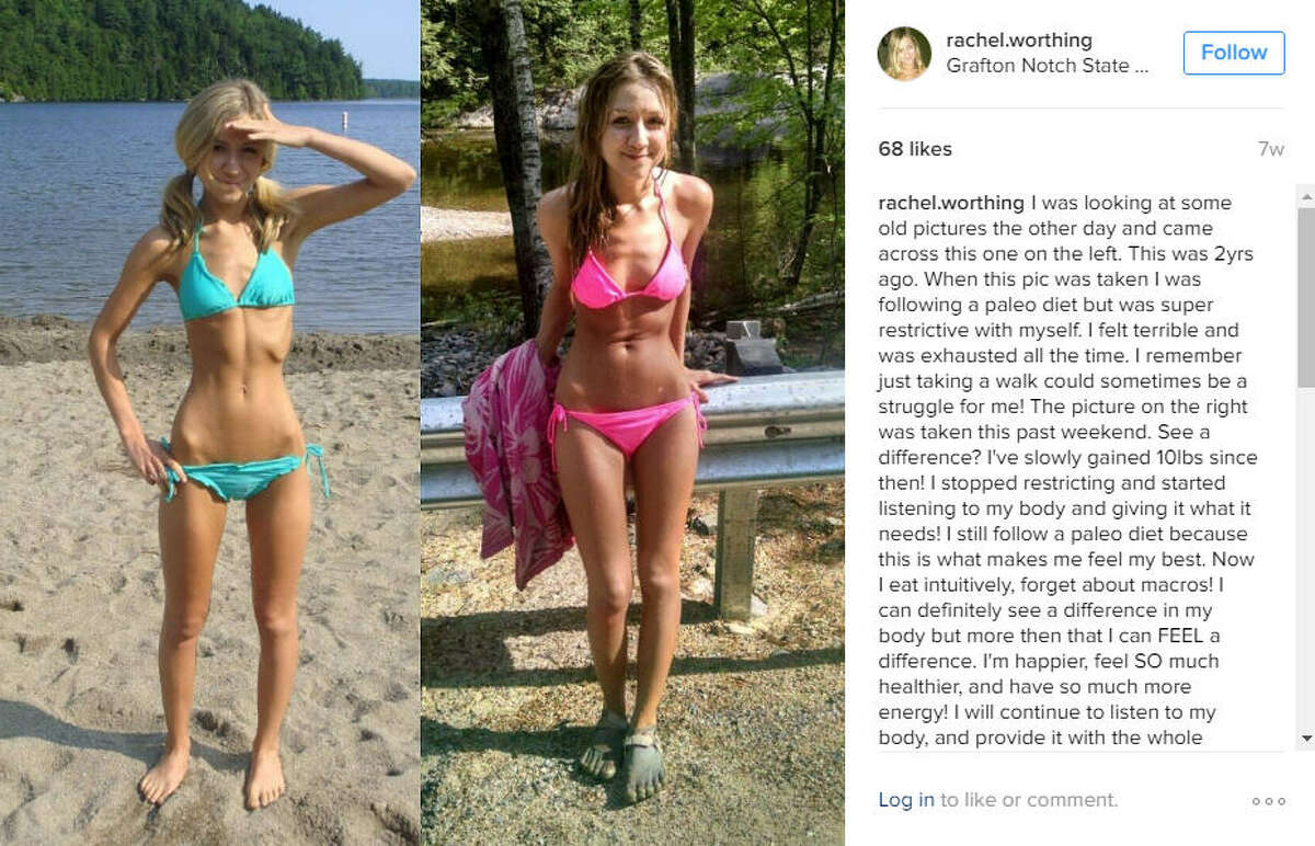Anorexia Survivor Shares Photos Of Amazing Recovery