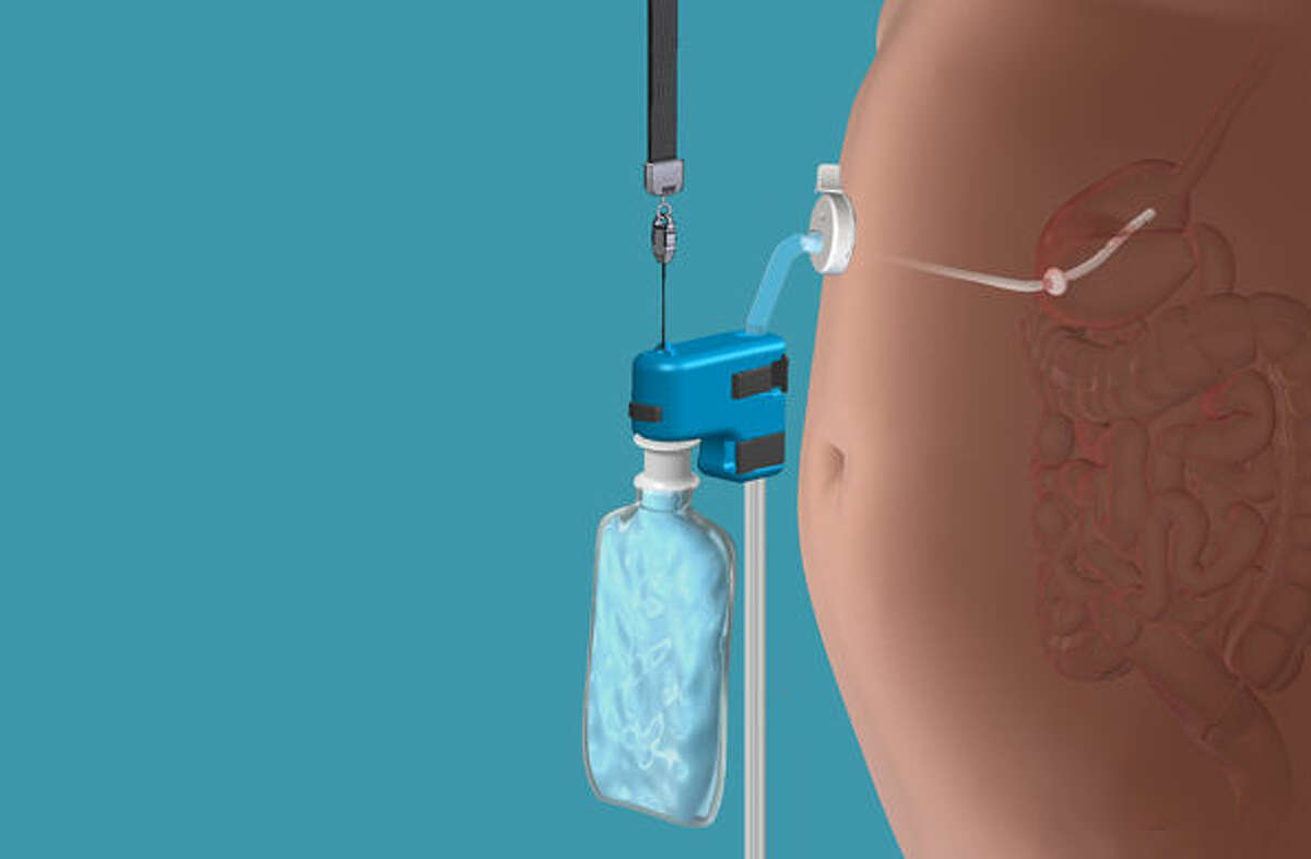 This rendering provided by Aspire Bariatrics, Inc. demonstrates the use of the AspireAssist weight loss device, approved by the Food and Drug Administration on Tuesday, June 14, 2016. The AspireAssist system consists of a thin tube implanted in the stomach, connecting to an outside port on the skin of the belly, which itself is connected to an external device, which helps remove nearly a third of the food stored in the stomach before calories are absorbed into the body, causing weight loss. (Aspire Bariatrics, Inc. via AP) MANDATORY CREDIT