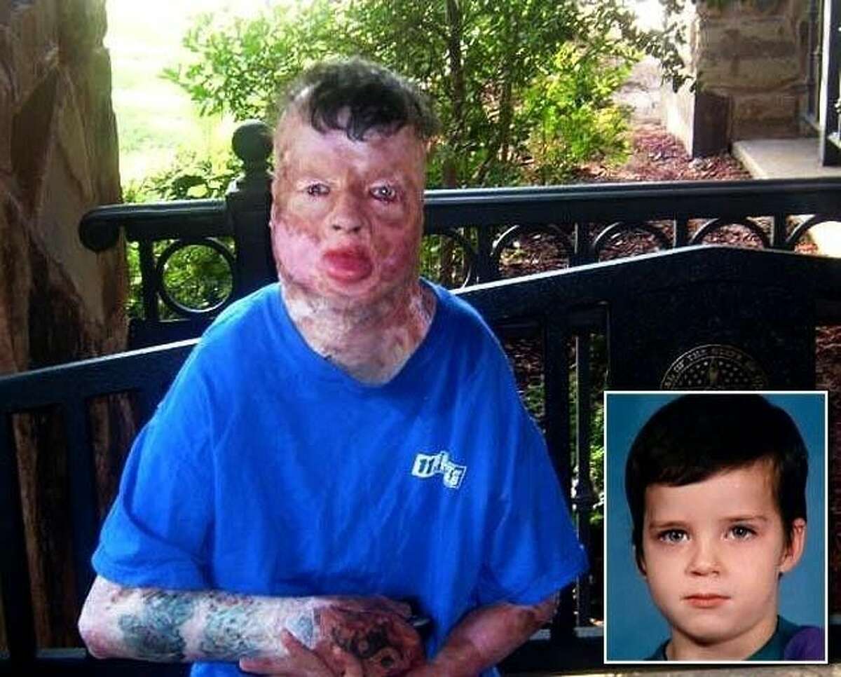 On Robert Middleton’s 8th birthday, he was doused with gasoline and burned over 99 percent of his body. He died at the age of 21.