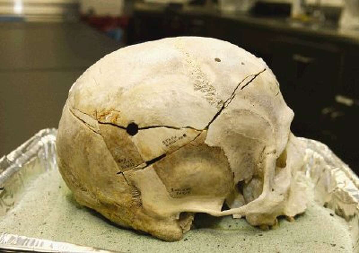 A bullet hole in the skull of a victim reveals the cause of death.