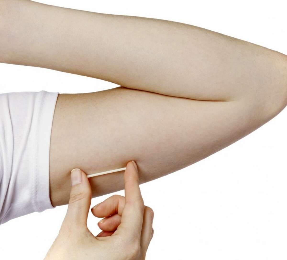 In this undated image provided by Merck, a model holds the Nexplanon hormonal implant for birth control.