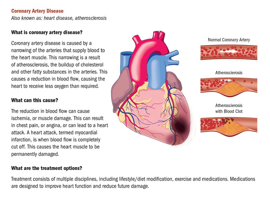 Known by heart. Coronary artery and miocrdial infarction localisation.