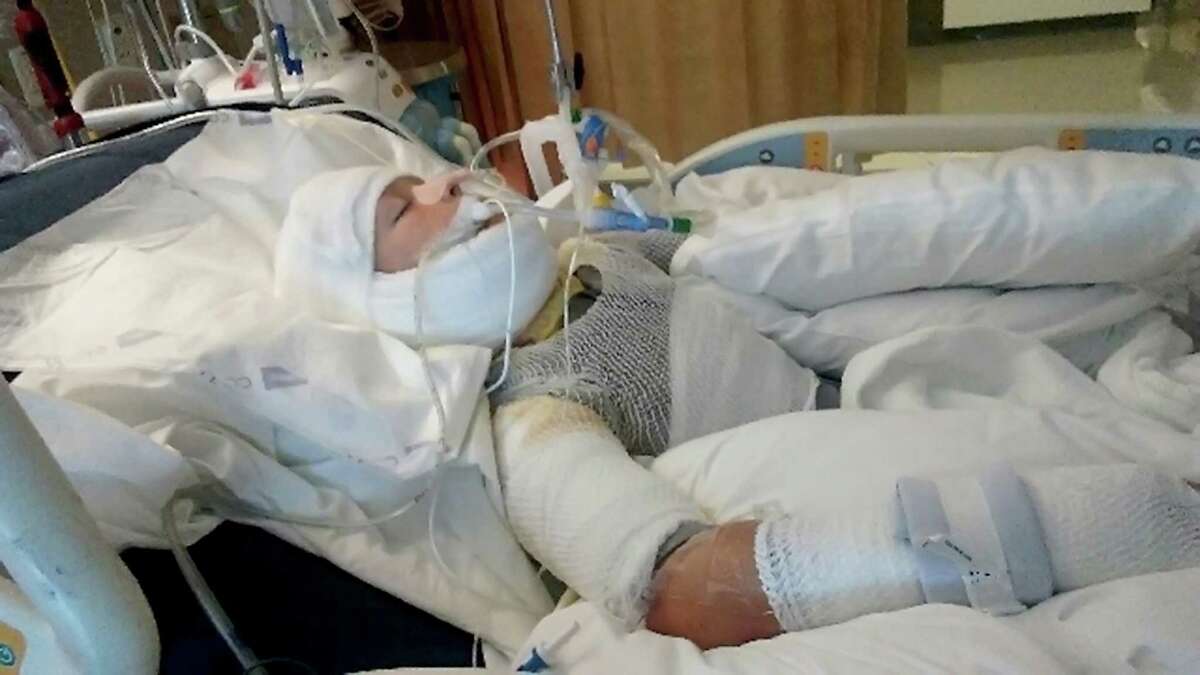 Kayden Culp, 10, lies in a University Hospital bed after suffering second degree burns he received while he was playing with other children over the weekend in Kerrville.