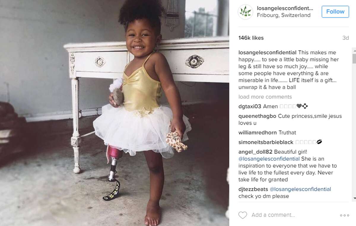 Aurora Cairo — also known as "Rory" — is the tenacious 2-year-old of Kayla Moore and Javon Cairo, from Seguin. She was diagnosed with fibular hemimelia, while still in the womb, which kept her right leg from developing. She underwent an amputation after birth, her mom recently told Buzzfeed.
