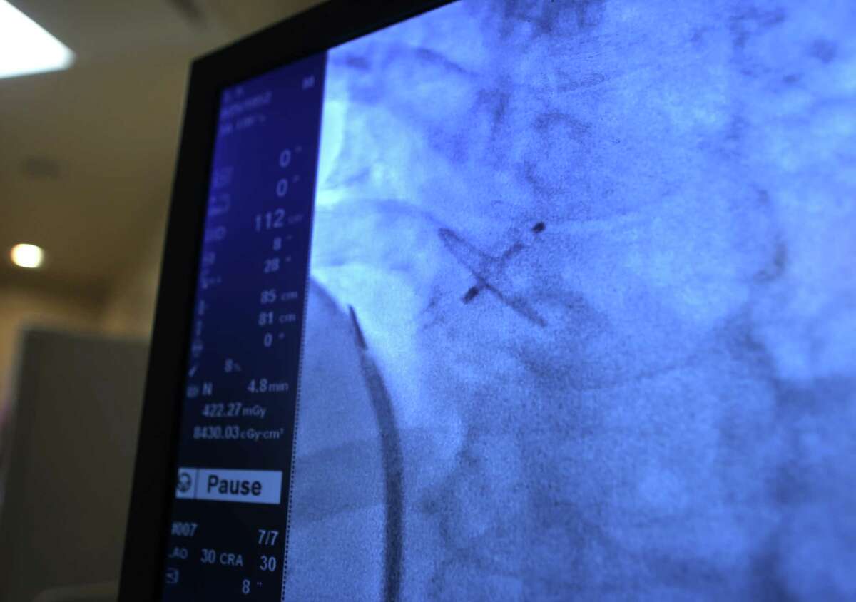 A live x-ray shows the device implanted in Arturo Garza's heart, Monday, Jan. 23, 2017, at Memorial Hermann Heart & Vascular Institute in Houston. Garza has suffered strokes in the past and a new study shows that implantation of the device should prevent ones in the future. The device can be installed through a catheter going from the groin area to the heart.