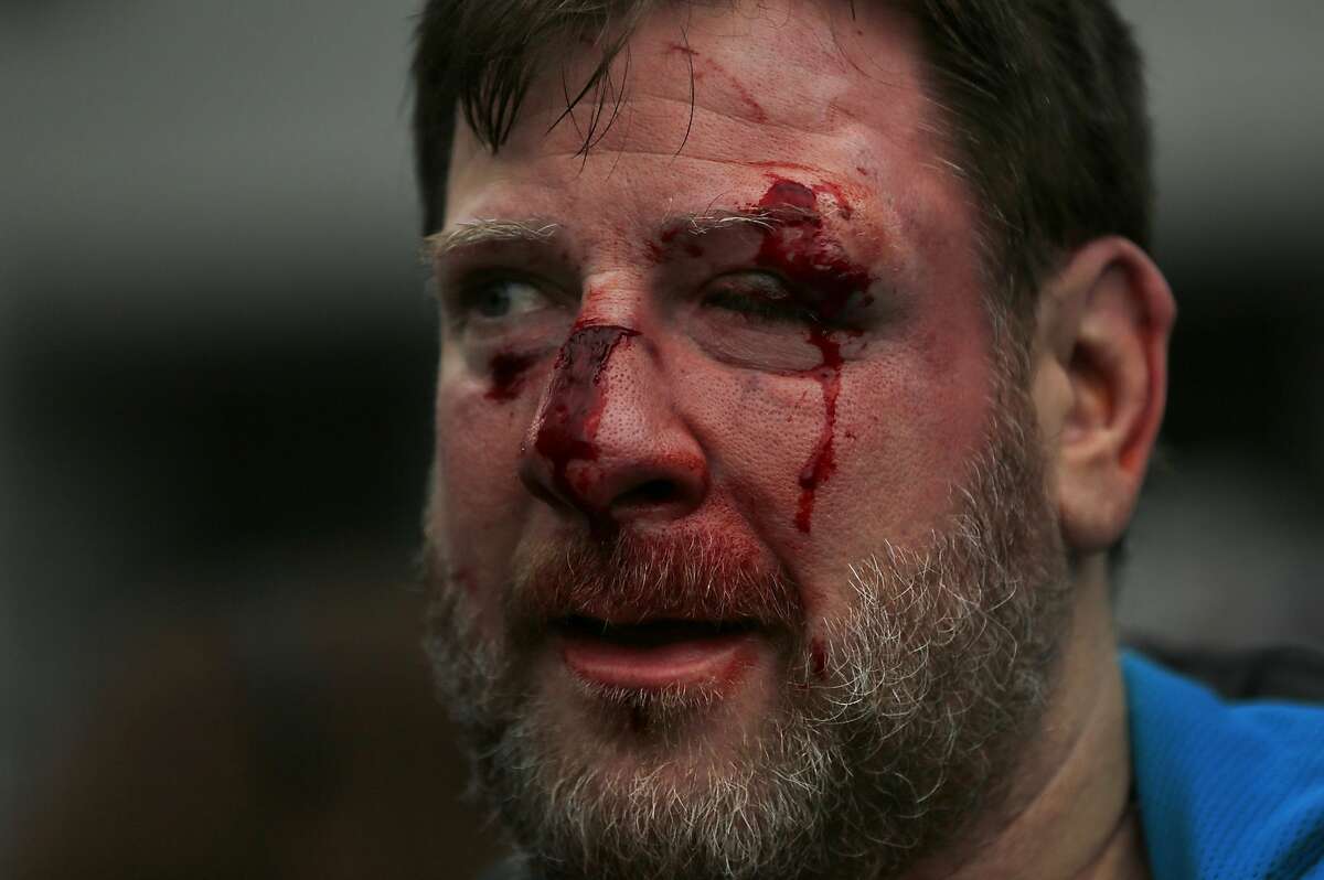 A Trump supporter who preferred not to give his name is seen with a bloodied face after repeatedly getting into physical fights with anti-fascist protesters during a Pro-President Donald Trump rally and march at the Martin Luther King Jr. Civic Center park March 4, 2017 in Berkeley, Calif.