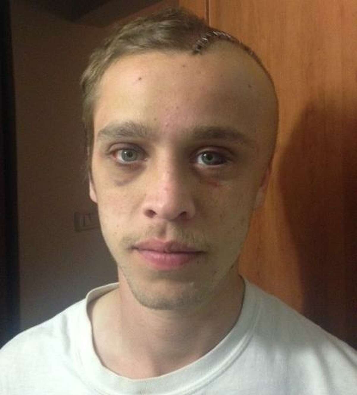 Pro skateboarder Raney Beres of San Antonio after an accident required surgery on his skull.