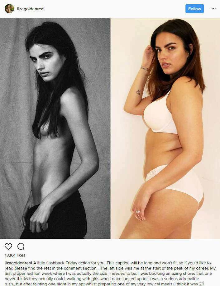 Model Who Ate 500 Calories A Day Shares Inspiring Photo Of Weight Gain After Leaving The