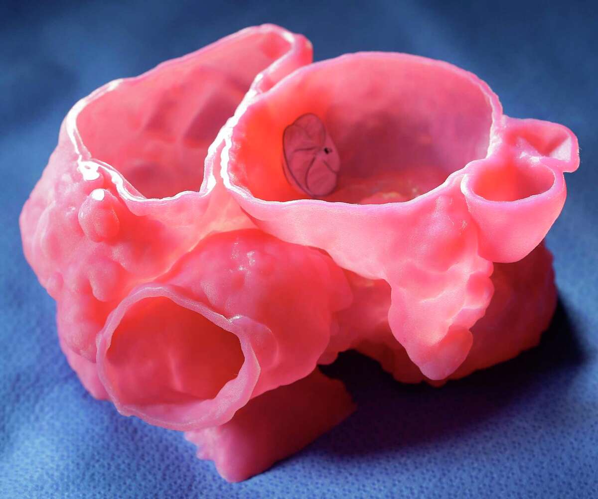 A 3-D printed medical model of a patient's ﻿heart﻿ was used to test a complex procedure to correct a congenital defect. Dr. Huie Lin at Methodist Hospital hopes the use of models will become more commonplace and that insurance companies will pay for them.