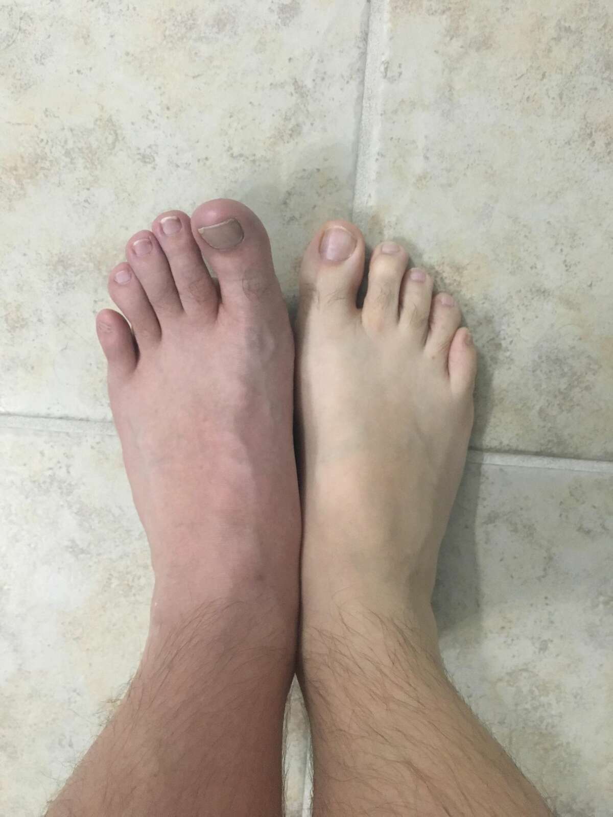 Walking barefoot at gym led to gross foot infection photos