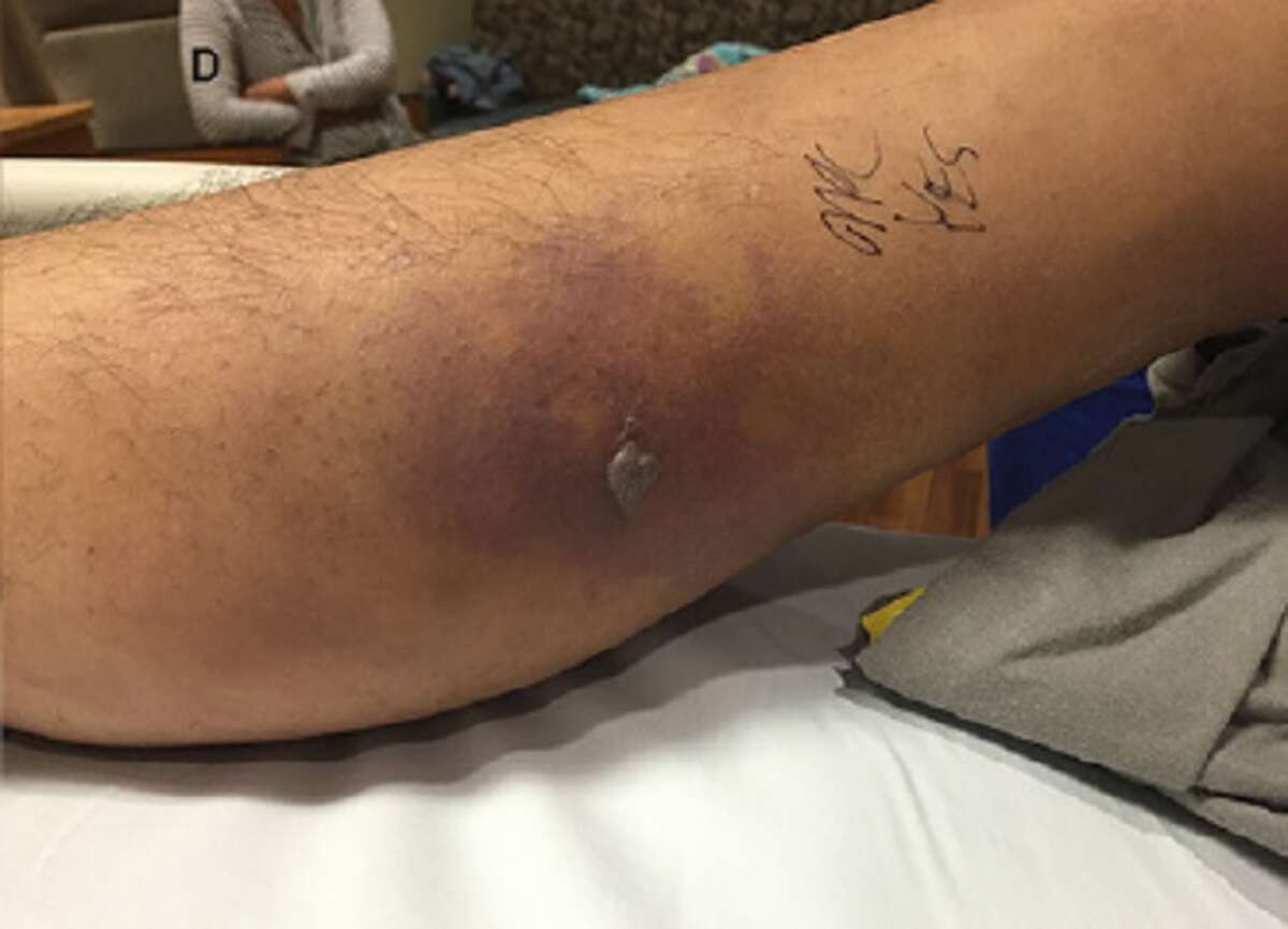 Report: Flesh-eating bacteria in Gulf of Mexico attack man's fresh tattoo; he died 2 months later