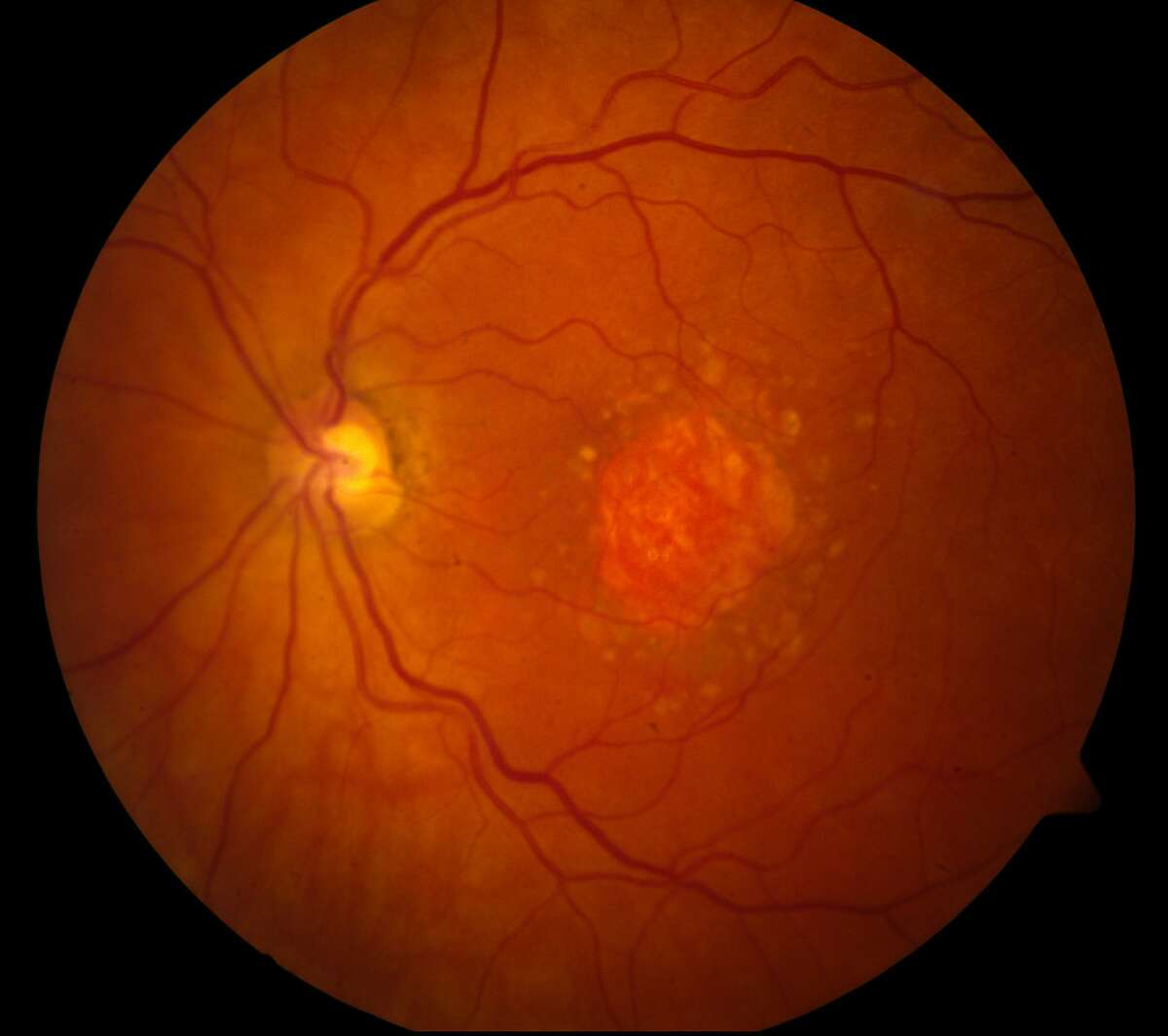 This image provided by the National Eye Institute shows a microscopic image of a retina being damaged by the so-called �dry� form of age-related macular degeneration. An experimental drug is showing promise against an eye disease that blinds older adults. Age-related macular degeneration gradually erodes seniors� central vision, making it difficult to read or see faces. (National Eye Institute via AP)