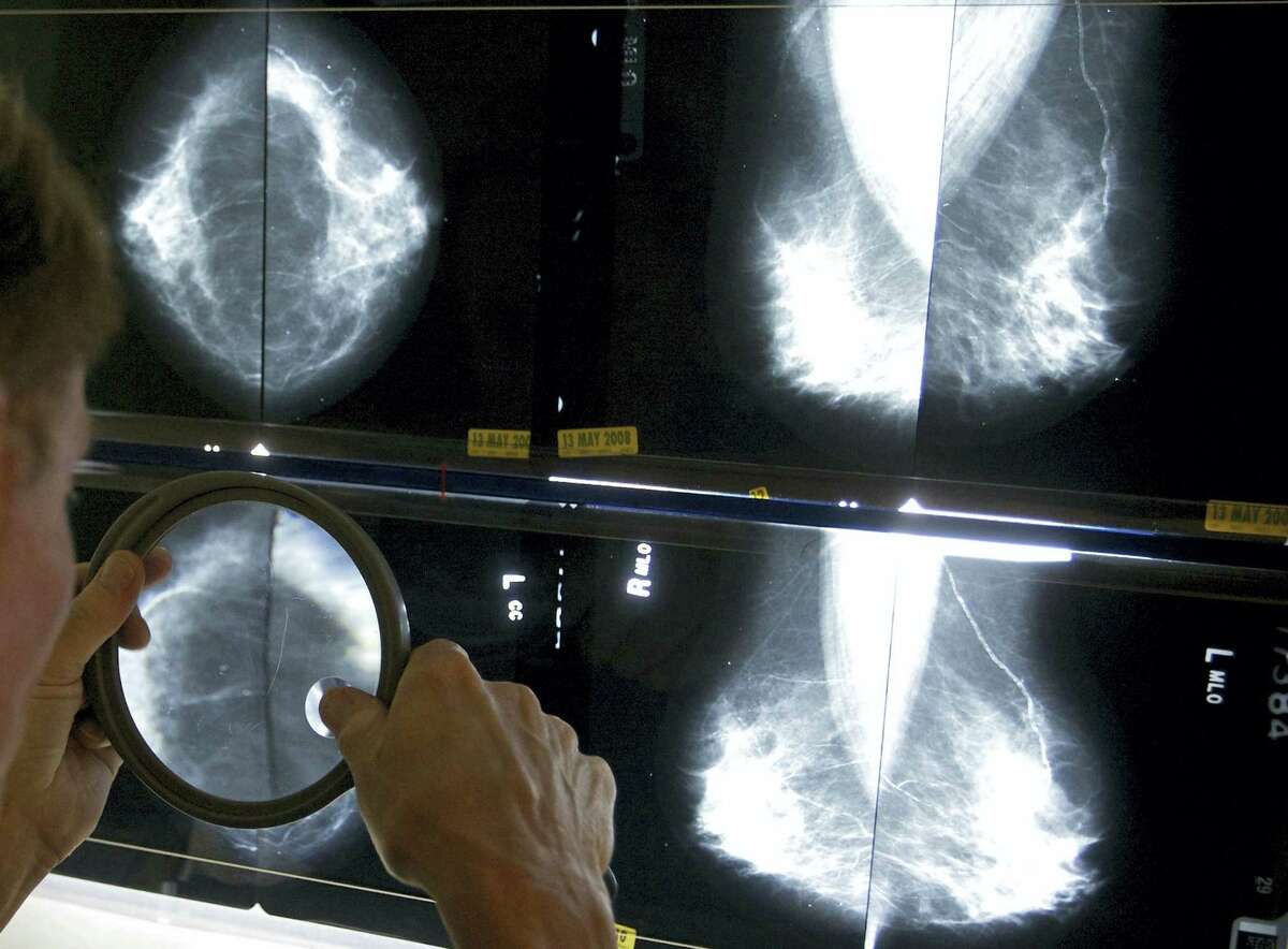 A radiologist uses a magnifying glass to check mammograms for breast cancer.