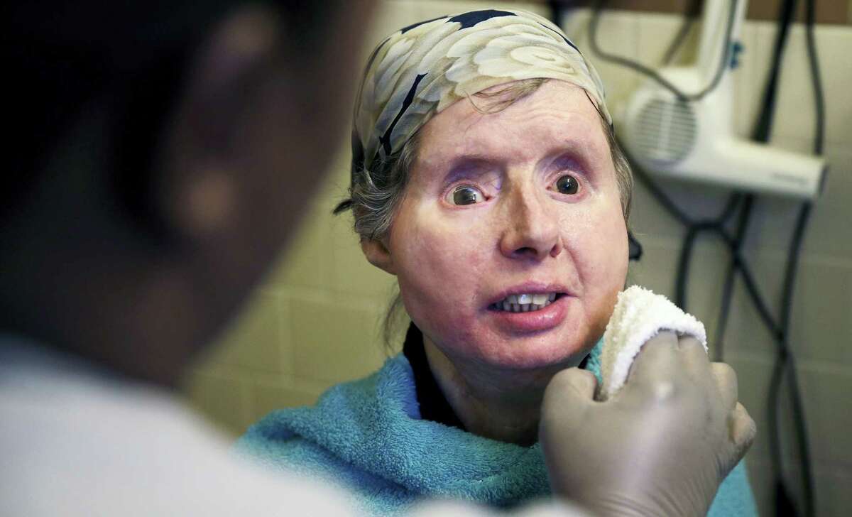 In this Feb. 20, 2015 file photo, Charla Nash smiles as her care worker washes her face at her apartment in Boston. The Connecticut woman who underwent a face transplant five years ago after being attacked by a chimpanzee is back in a Boston hospital after doctors discovered her body is rejecting the transplant.