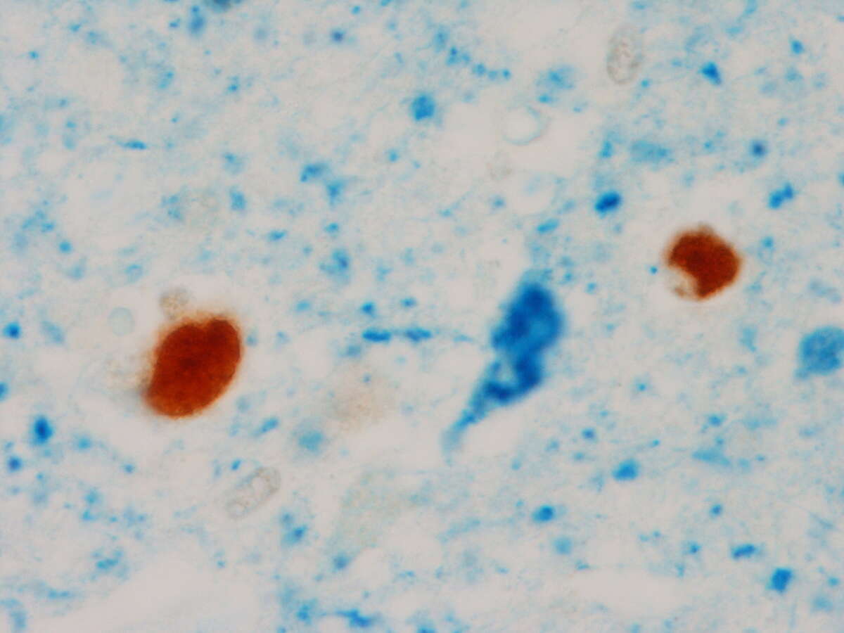 This undated image provided by the Mayo Clinic shows an abnormal TDP-43, the two circular brown blobs, in the brain of a patient with tau neurofibrillary tangle, blue flame shape blob in the middle, and Alzheimerís disease during the pathological analyses in Rochester, Minn. Scientists have linked a new protein to Alzheimer’s disease, different from the amyloid and tau that make up the sticky brain plaques and tangles long known to be its hallmarks and was discussed Wednesday, July 16, 2014, at the Alzheimer’s Association International Conference in Copenhagen.