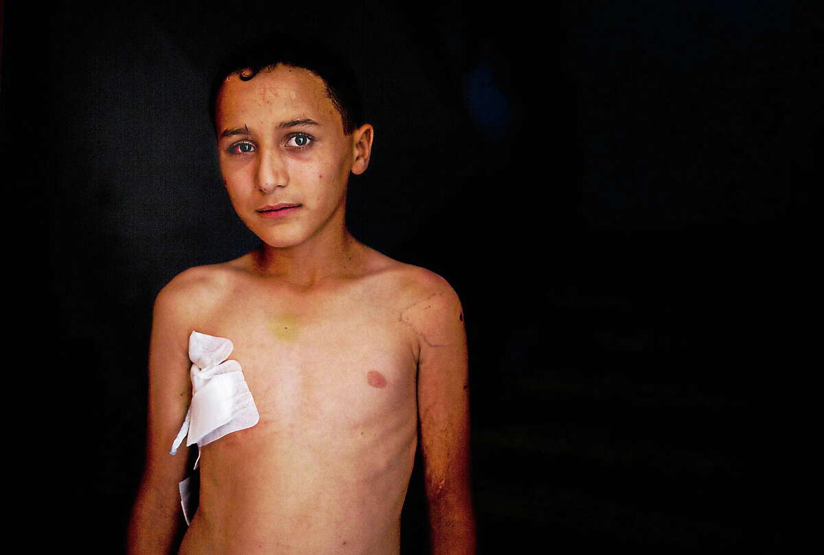 This photo made on Aug. 6, 2014 shows 10-year-old Abdul-Qader Sahweel, who was wounded at UNRWA school on July 30, 2014, and suffered shrapnel wounds to his chest and eye, standing in his home in Gaza City.