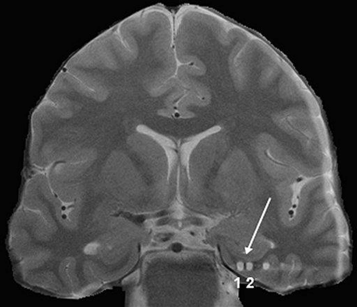This undated image provided by the Fried Lab/UCLA shows a brain MRI with an arrow, showing where researchers applied deep-brain stimulation during tests on learning. A painless bit of electrical current applied to the brain helped some people play a video game, and someday it might help Alzheimer's disease patients remember what they've learned, a small study suggests. Associated Press