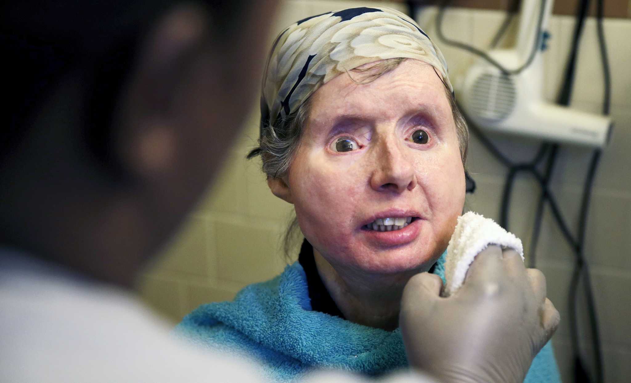 Chimp attack victim Charla Nash hospitalized with facetransplant