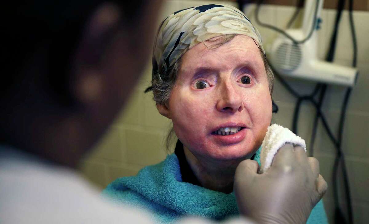 Charla Nash smiles Feb. 20 as her care worker washes her face at her apartment in Boston. The Department of Defense is following Nash’s progress, after funding her transplant surgery in 2011. Nash lost her face, eyes and hands after being mauled by a chimpanzee in 2009.