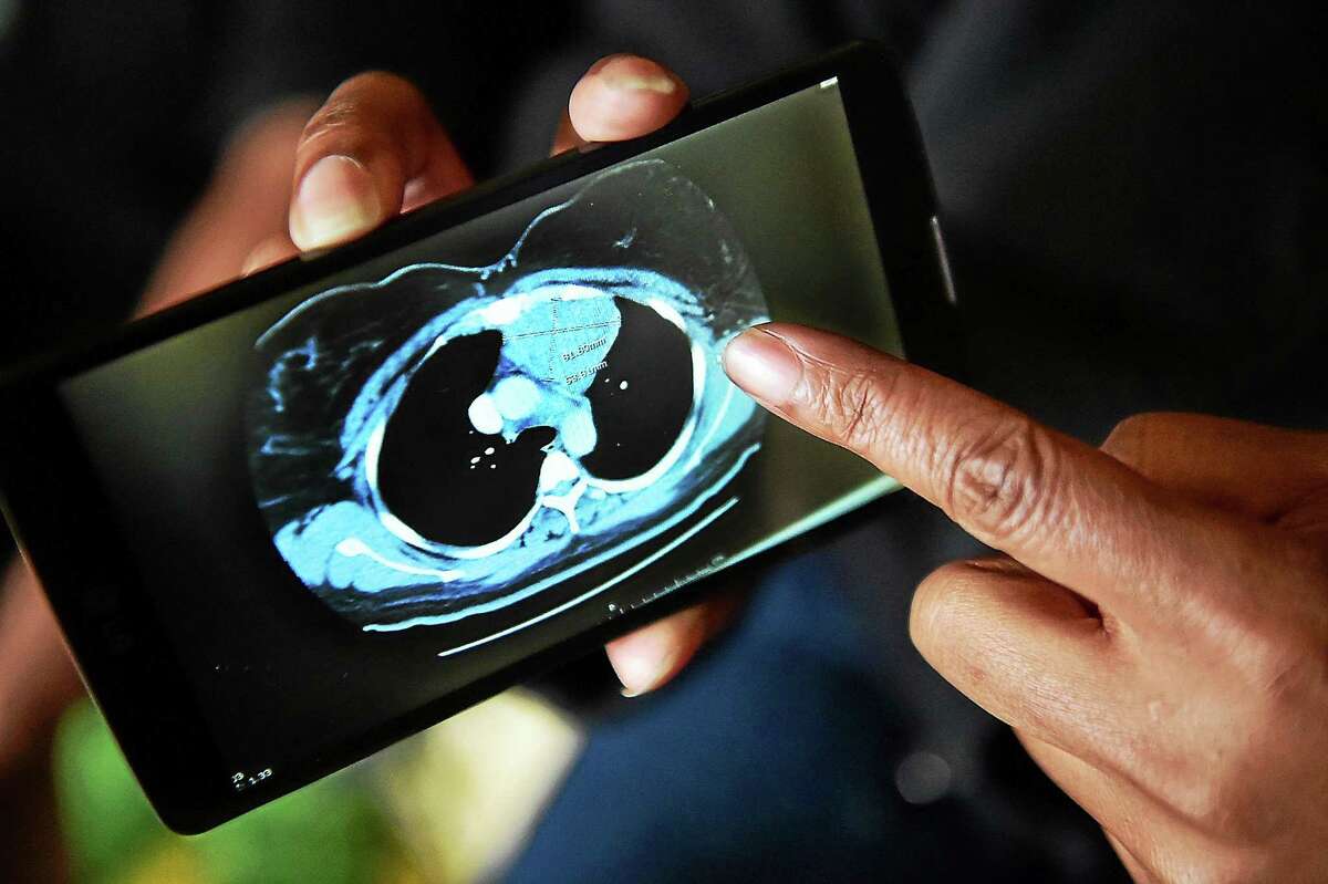 Branford resident Cheryl Speller shows the CT scan of the tumor in her breast, 81.89mm x 53.81mm in size, on her smart phone, Wednesday, April 8, 2015.