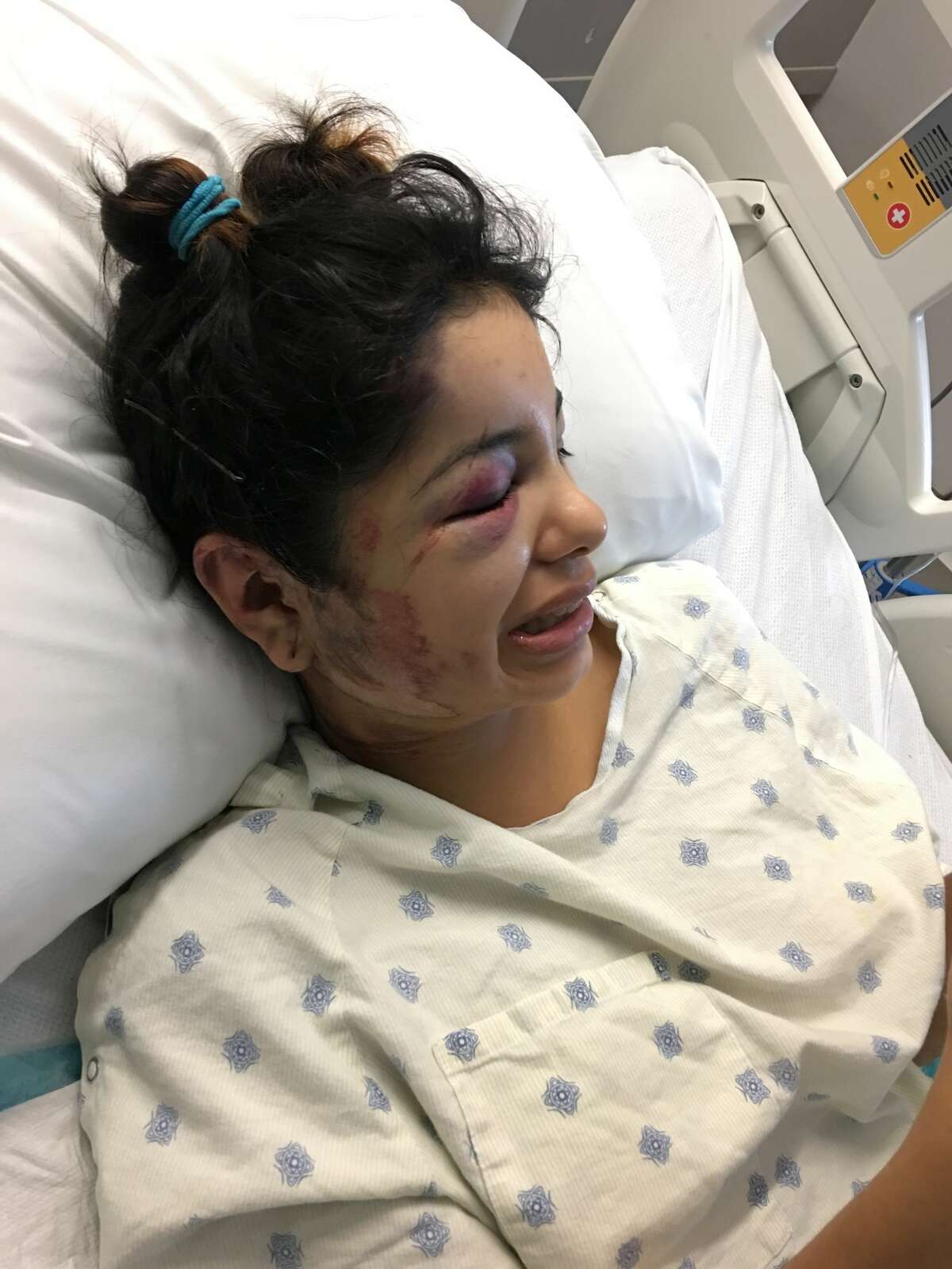 Ashley Martinez, the 21-year-old skateboarder who was run over by a car on Sept. 20, 2017, in the 5300 block of DeZavala Road, shared graphic photos of her injuries with mySA.com. Nathan Thomas Losoya, 19, has been arrested on suspicion of failing to render aid in the case.