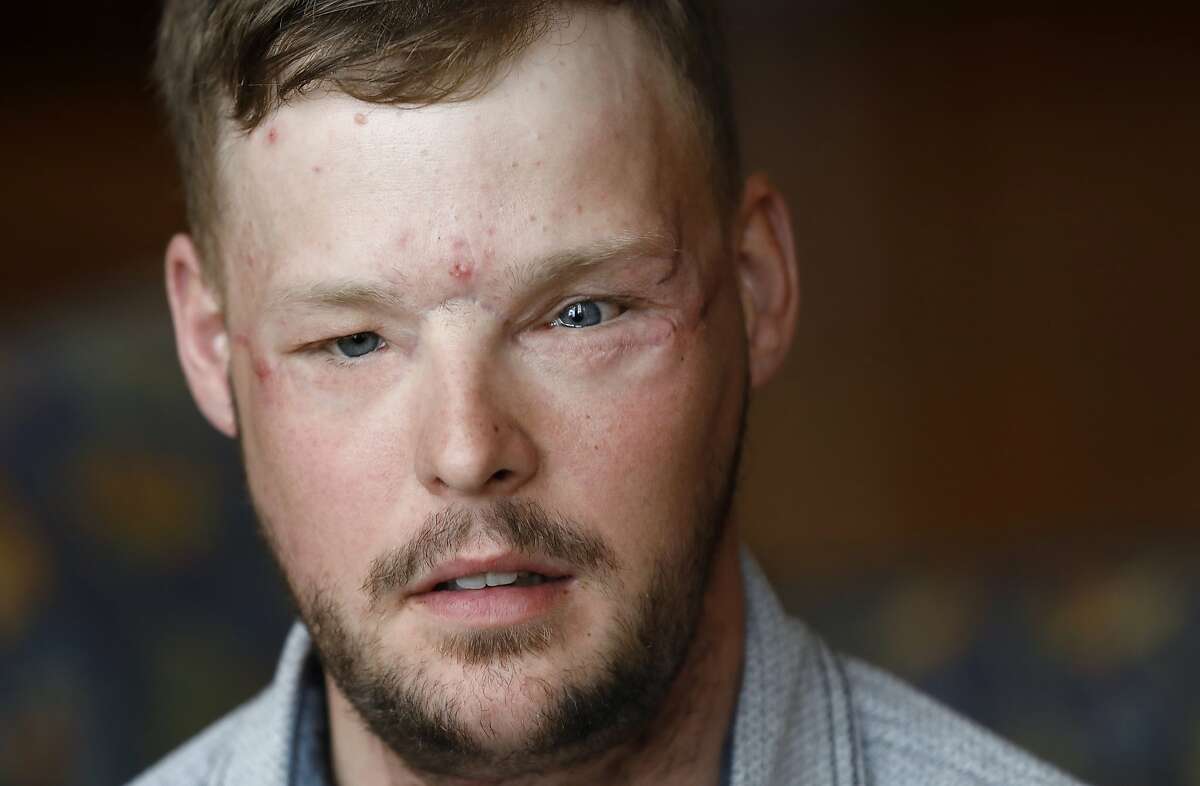 Face transplant recipient Andy Sandness speaks during an interview Friday, Oct. 27, 2017, at the Mayo Clinic in Rochester, Minn. Life with a transplanted face takes work, every day. Sandness is on a daily regimen of anti-rejection medication. He�s constantly working to retrain his nerves to operate in sync with his new face, giving himself facial massages and striving to improve his speech by running through the alphabet while driving or showering. (AP Photo/Charlie Neibergall)