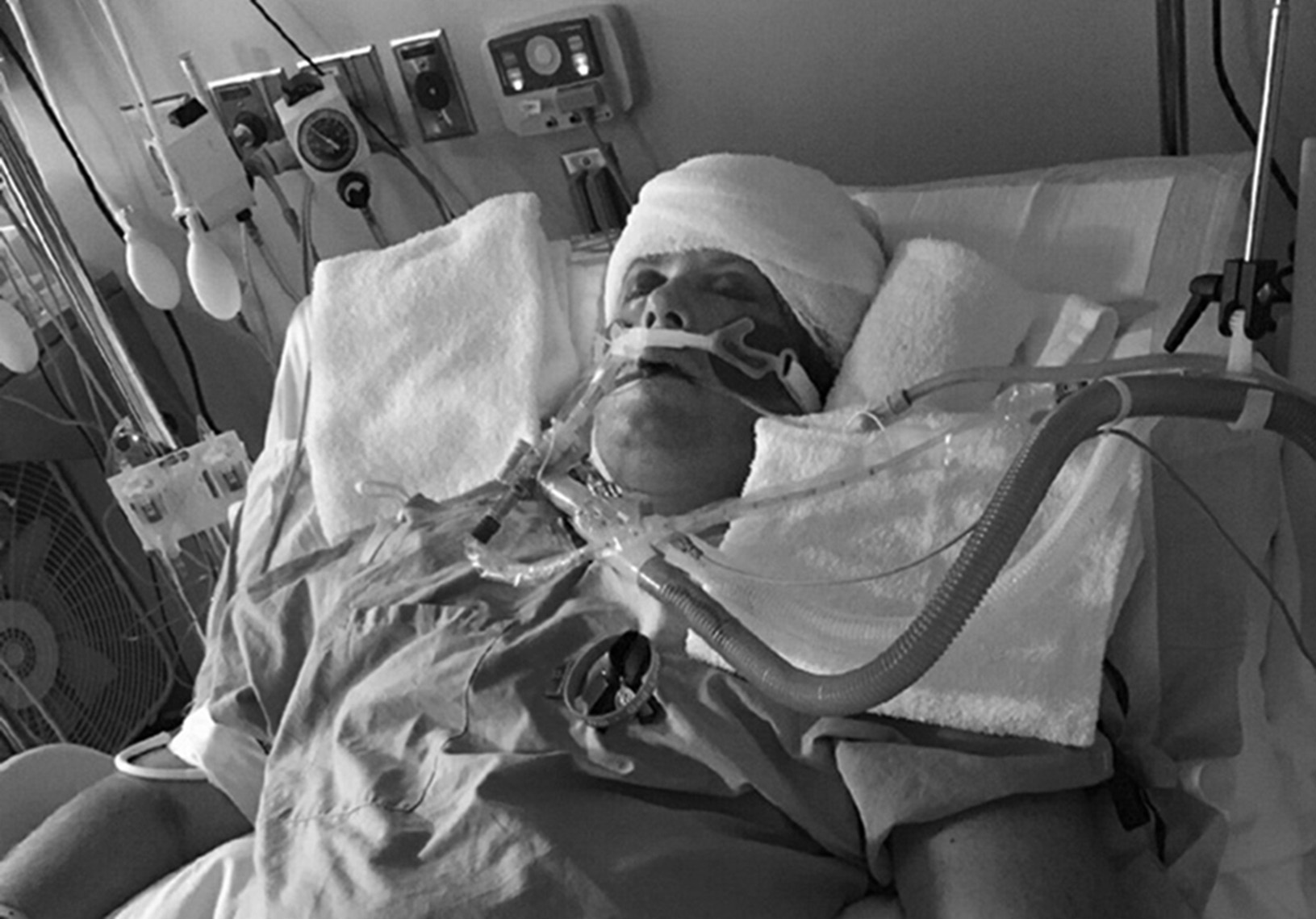 Broken Bones Iv Brain Damage