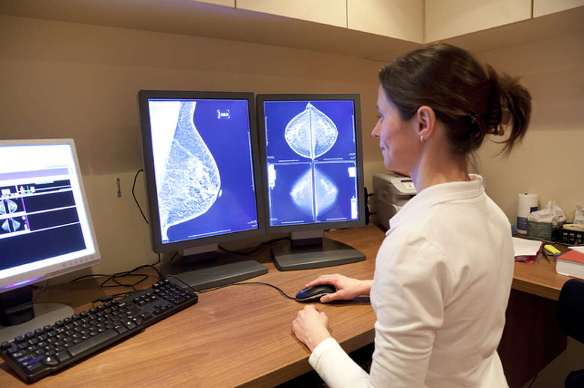 Nearly 65,000 women a year -- about 22 percent of those with breast cancer -- are diagnosed with DCIS, also known as Stage 0 breast cancer. (Photo courtesy Fotolia/TNS)