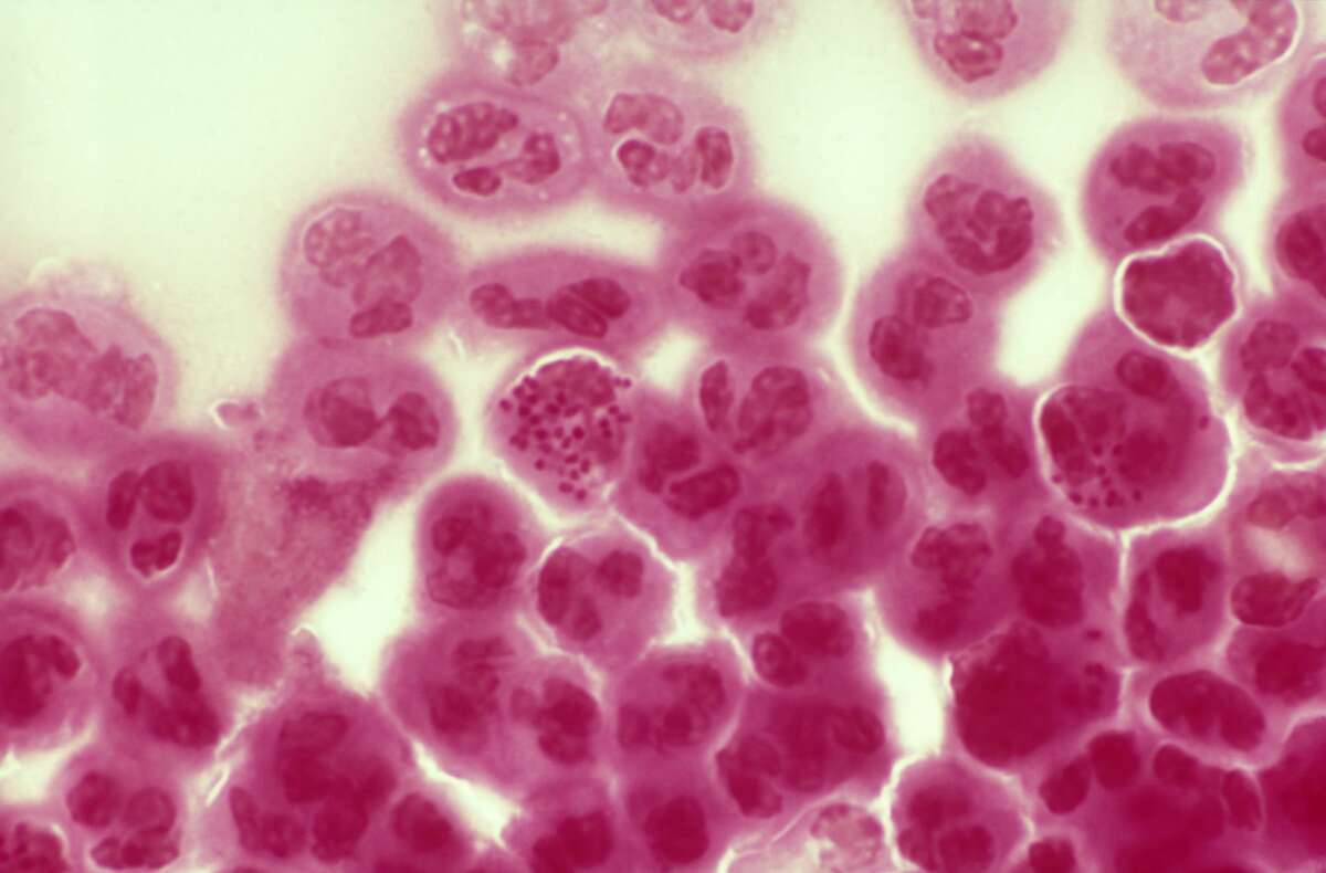 In the U.S., gonorrhea diagnoses increased 67 percent, nearly doubling among men.