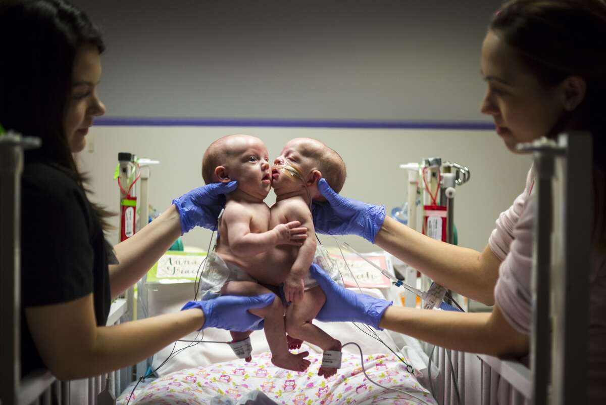 Conjoined Twin Girls Separated At Texas Children S