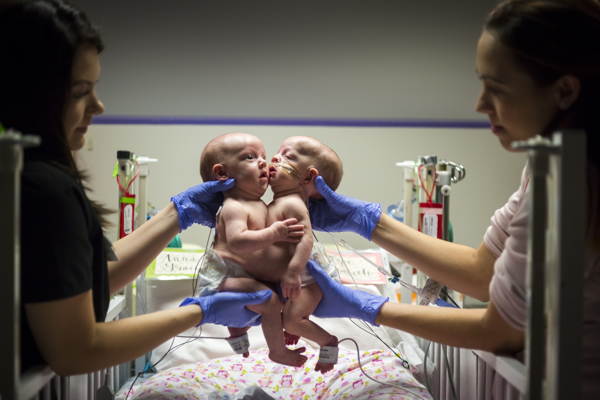Conjoined Twin Girls Separated At Texas Children S