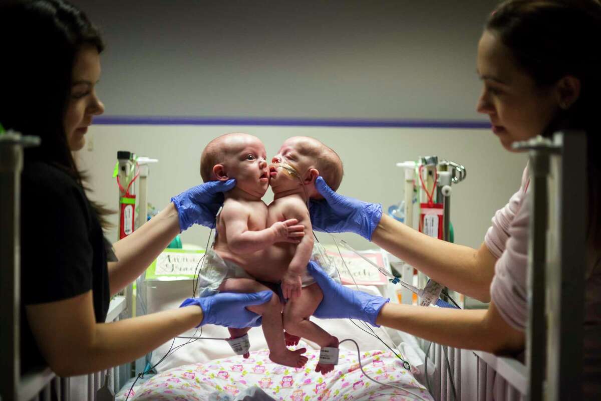 Anna and Hope Richards, shown at 2 months old last February while conjoined at their chest and abdomen, were successfully separated last month at Texas Children's Hospital.