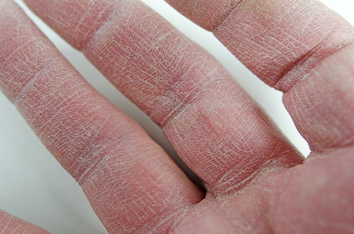 reasons-for-skin-peeling-on-hands-home-easy-natural-remedies