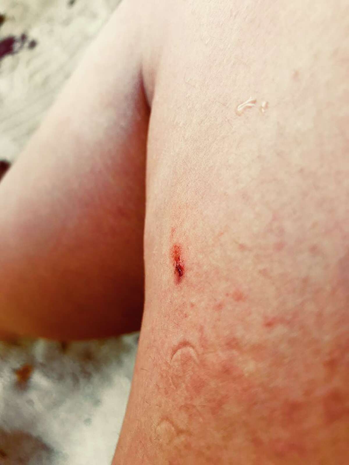 Veronica De La Cruz's leg drips with blood after a small fish bit her while snorkeling in Thailand