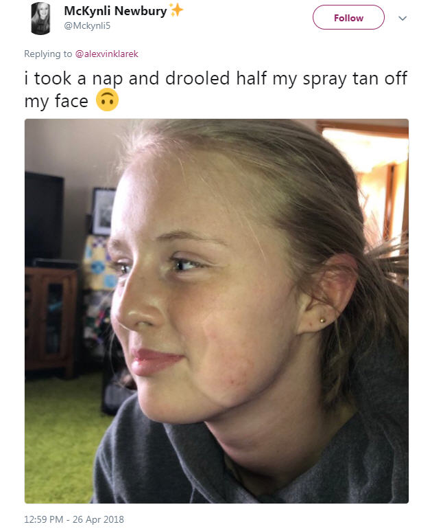 Fake tan fail leaves teenager housebound for a week