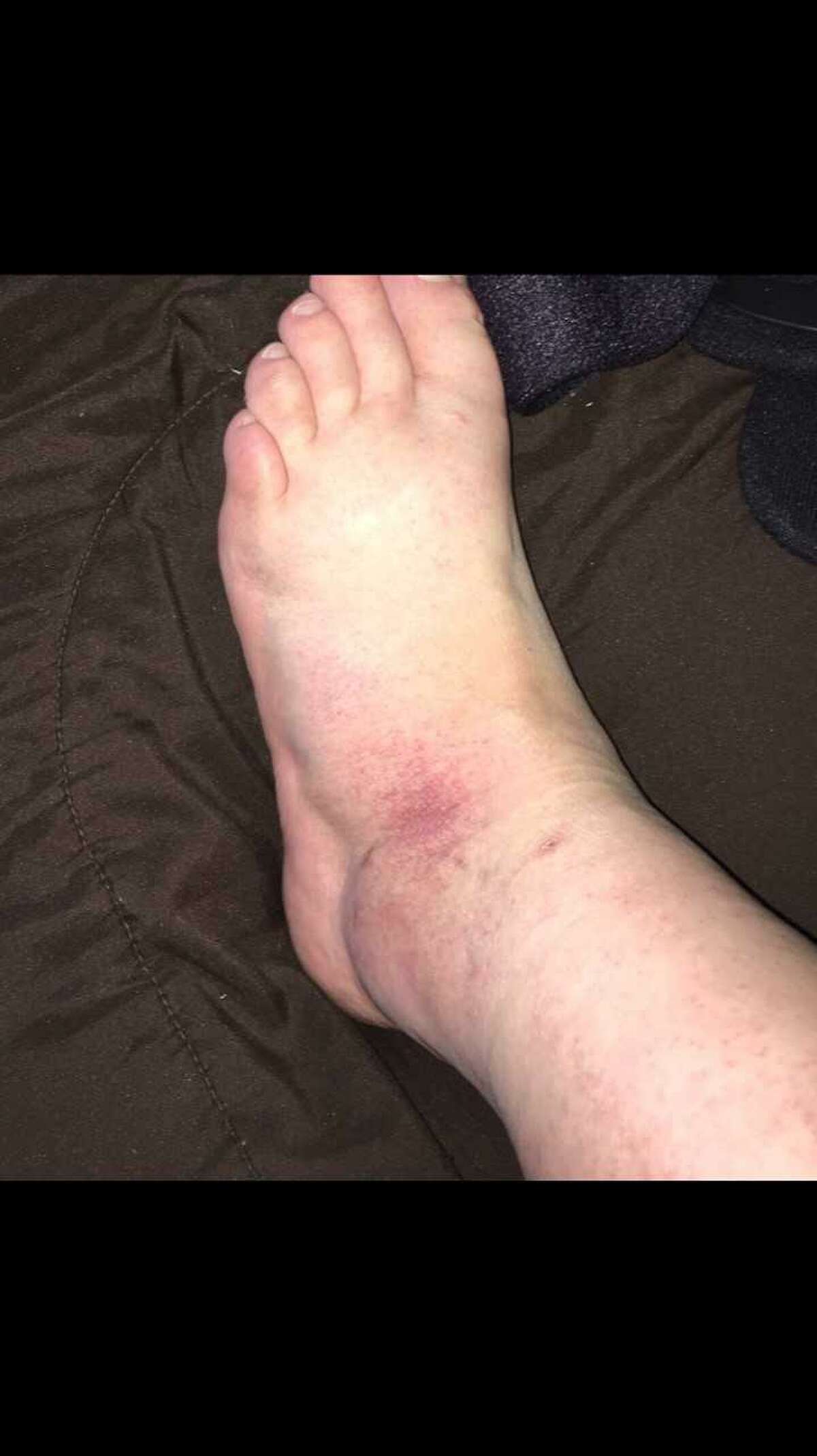 This Simple Symptom Led To My Bone Cancer Diagnosis - b6syjqg