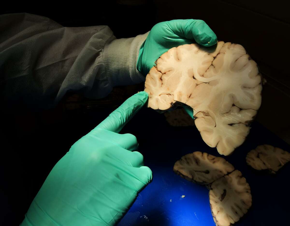 A Boston researcher analyzes brain tissue for a disease that has been found in some NFL players who died or committed suicide.