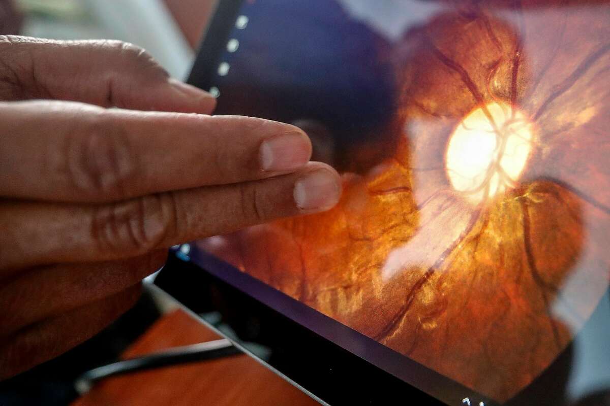 A new model of the Optovue iCam, a retinal camera is demonstrated in Jorge Cuadros, OD, PhD office in San Jose, California. Monday, May 7, 2018. Cuadros is using Google's AI technology to help determine if patients have diabetic retinopathy, a disease that can cause blindness.