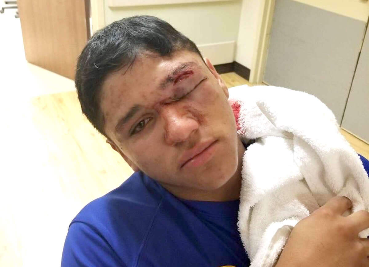 Evadale Rebels starting pitcher Alex Valencia was transported to Huntsville Memorial Hospital after being struck above the left eye by a line drive in the first inning of Friday’s playoff game with Thorndale. (Photo provided by Arnold Valencia)