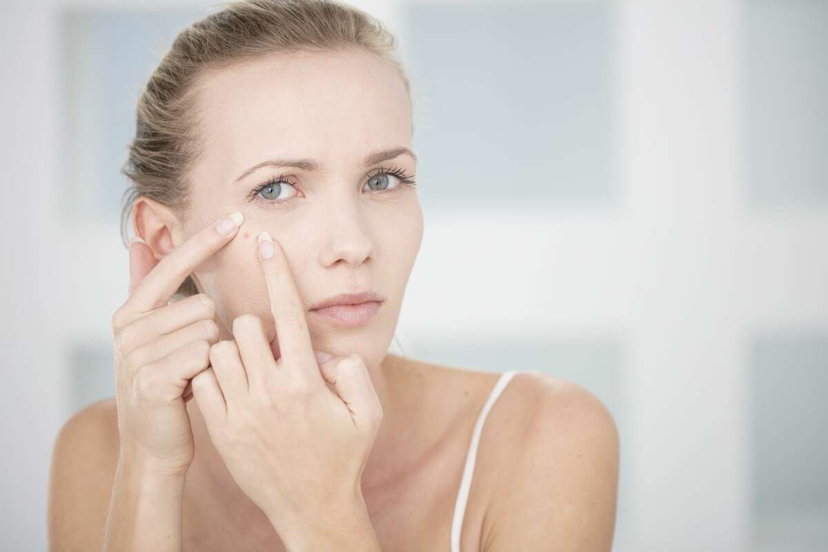 Scientists at the University of California, San Diego say they are one step closer to developing an acne vaccine.