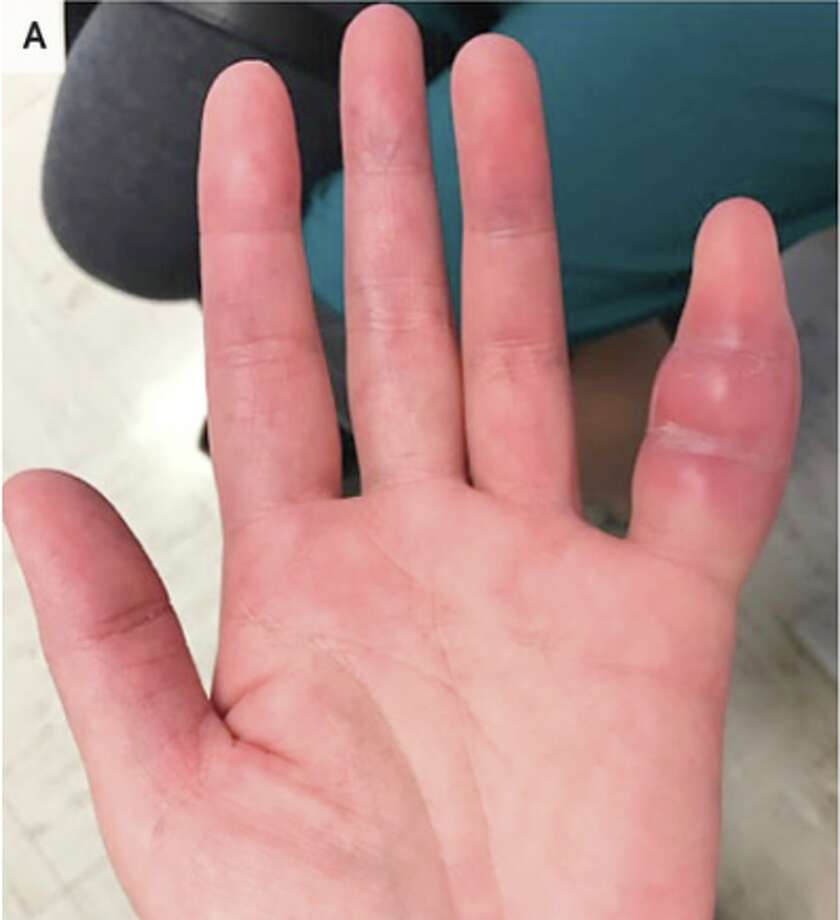 A 42-year-old woman who was neat after a week of swelling and discomfort rose finger was found infected with Mycobacterium tuberculosis. Photo: New England Journal Of Medicine