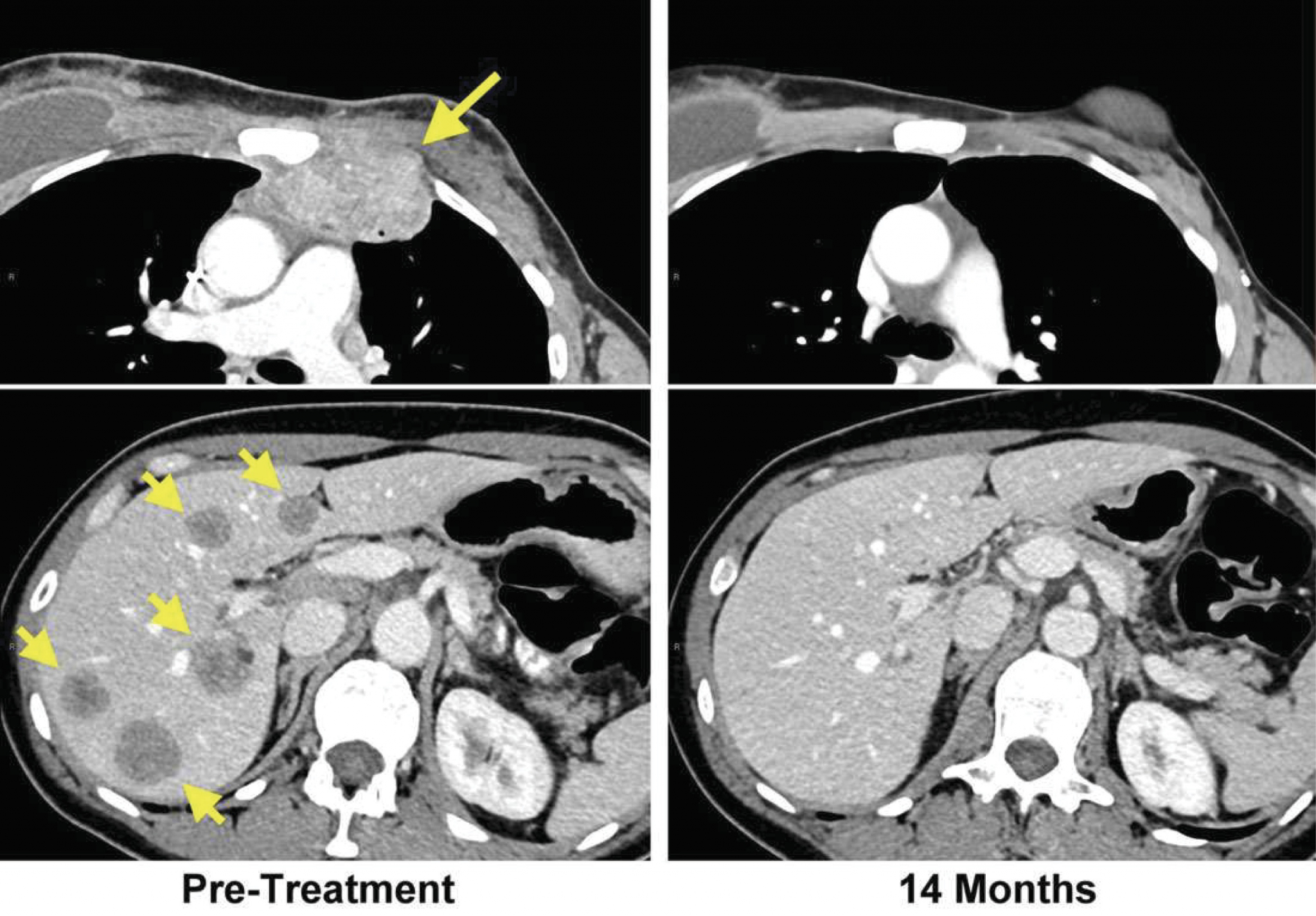 Рак молочной железы метастазы в легких. Терминальная стадия онкологии. Опухоль грудной стенки кт. Опухоль в терминальной стадии.