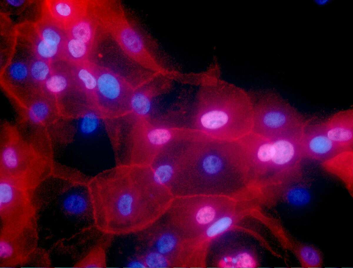FILE - This undated fluorescence-colored microscope image made available by the National Institutes of Health in September 2016 shows a culture of human breast cancer cells. For the first time, one of the new immunotherapy drugs has shown promise against breast cancer in a large study that combined it with chemotherapy to treat an aggressive form of the disease. Results were discussed Saturday, Oct. 20, 2018 at a European Society for Medical Oncology conference in Munich and published by the New England Journal of Medicine. (Ewa Krawczyk/National Cancer Institute via AP)