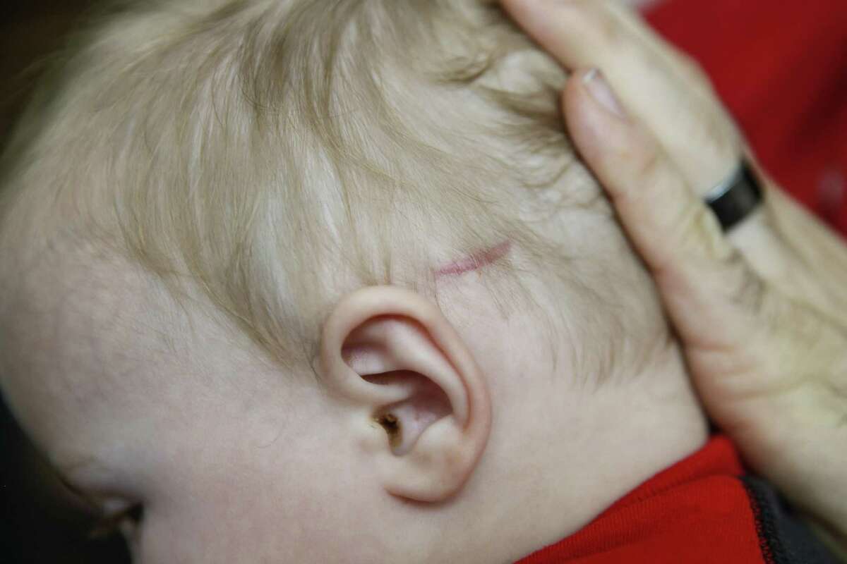Dillon Bright shows a scar on the skull of his nine-month-old son, Mason Bright, which he received from surgery to insert a stent Saturday, Nov. 3, 2018, in Tomball. Child Protective Services is facing sanctions after improperly removing the Bright's children from their home after Mason's fell and fractured his skull when he was five months old.