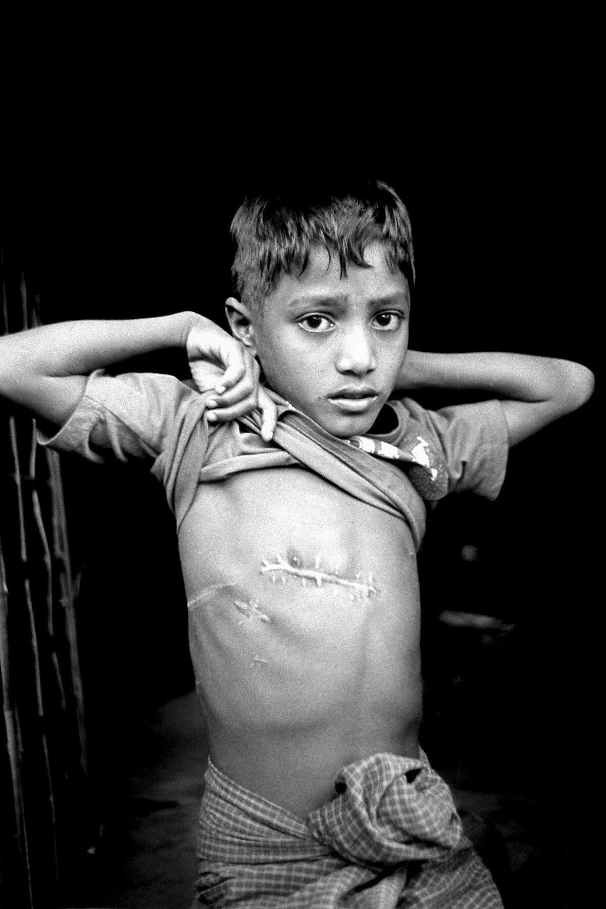 Mohamed Shoaib, 7, a Rohingya boy from Maungdaw, Myanmar, was shot in the chest by government security forces while waiting near the border of Bangladesh for a boat driver to help him escape into that country. Kutupalong, Bangladesh 2017.