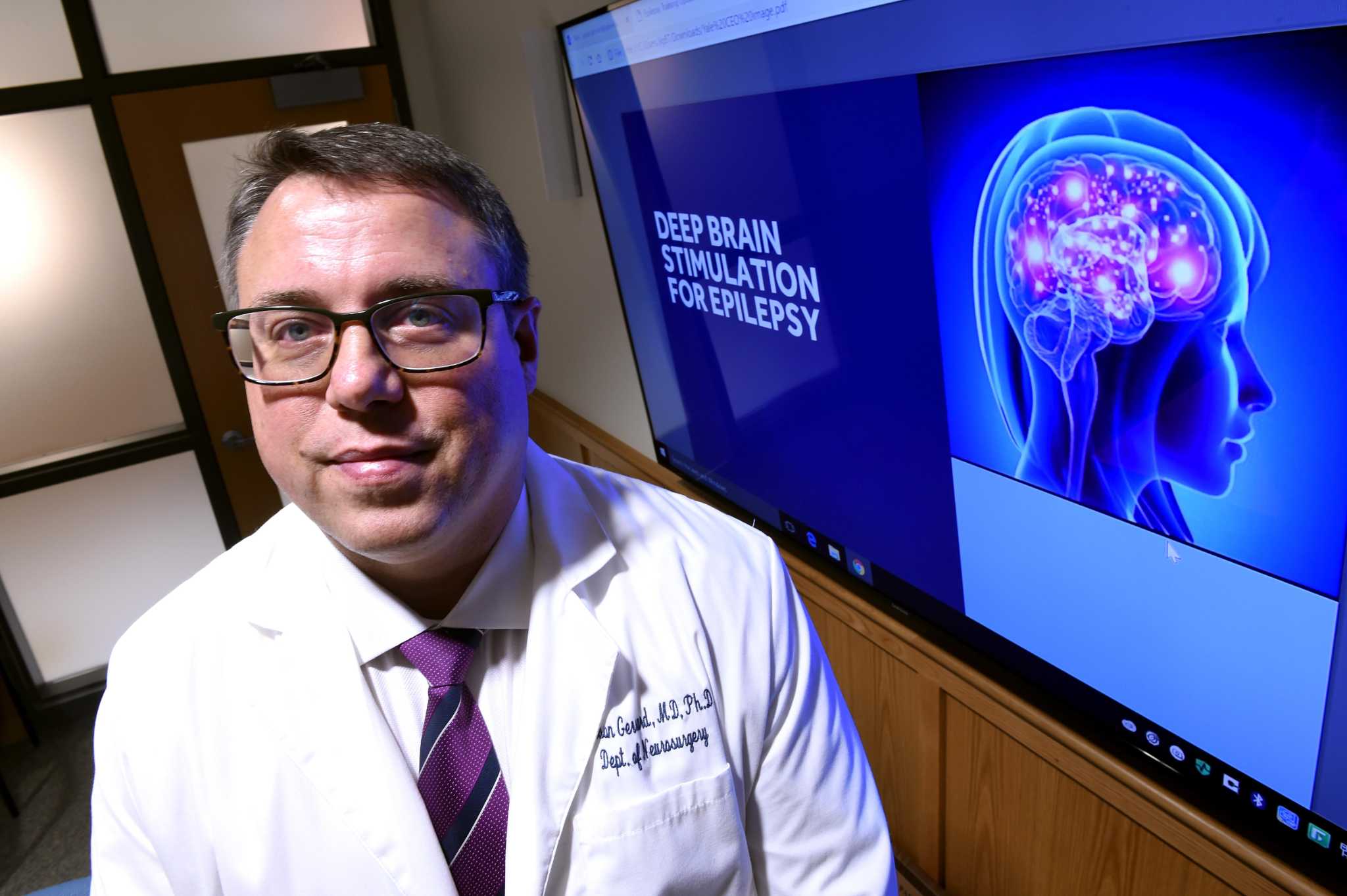 new-surgery-treats-epilepsy-with-deep-brain-stimulation